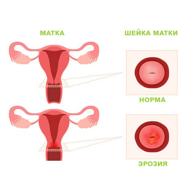 Лечение эрозии шейки матки в Великом Новгороде