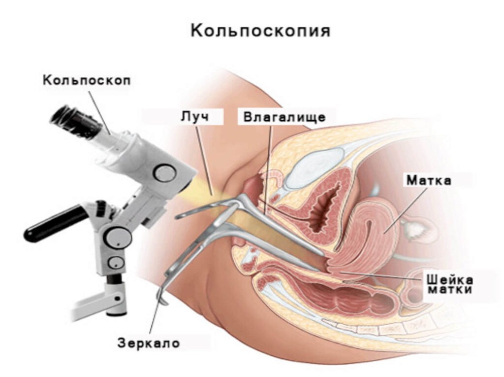 Кольпоскопия шейки матки схема