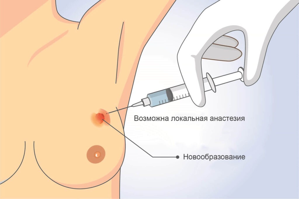 Тонкоигольная пункционная биопсия щитовидной и молочных желез